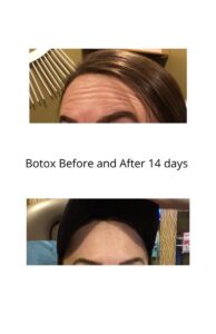 Botox® Treatment in Commack, NY
